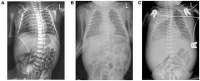 Congenital tuberculosis in a neonate following in vitro fertilization-embryo transfer: A case report